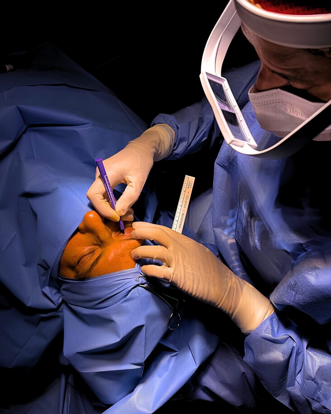 Dra. Samyra Chamoun demarcando a pálpebra com caneta cirúrgica e régua milimétrica antes da blefaroplastia